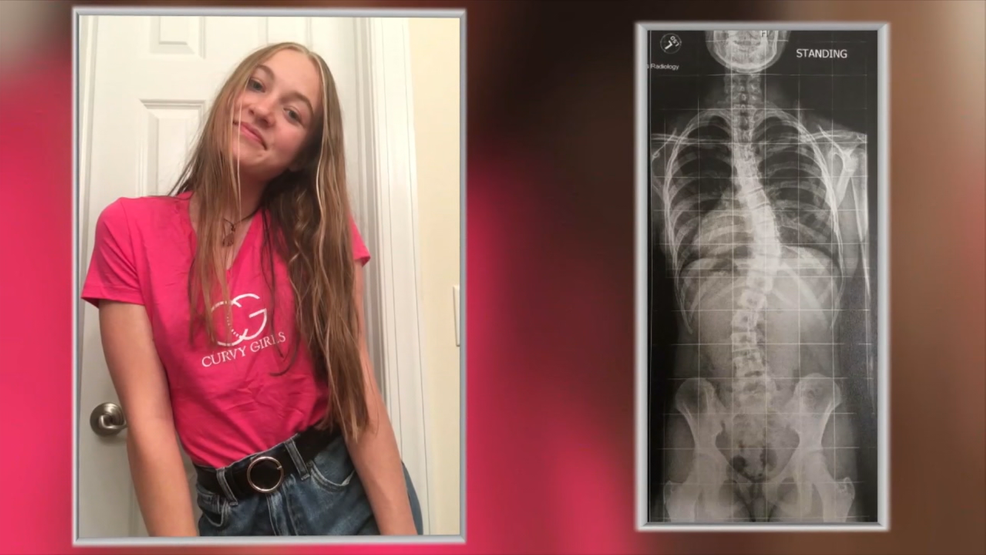 Its Going To Make You Stronger Asheville Teen Mentors Others With Scoliosis Wlos